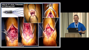 An image from the "Achilles Repair: Acute Achilles Tendon Rupture with Thomas Roukis, DPM, PhD, FACFAS" video on the JnJInstitute.com website.