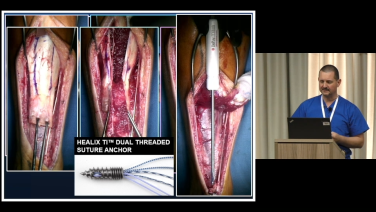 An image from the "Achilles Repair: Chronic Achilles Tendon Rupture with Thomas Roukis, DPM, PhD, FACFAS" video on the JnJInstitue.com website.