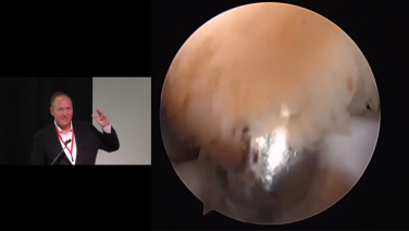 An image from the "How I do a Remplissage with Mark Mighell, MD" video on the JnJInstitute.com website.