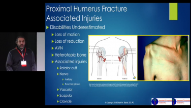 An image from the "Proximal Humerus Open Reduction Internal Fixation: Locked Plating with Shariff Bishai, DO" video on the JnJInstitute.com website.