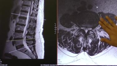Anterior to Psoas (ATP): Pre-operative Planning with Chi Lim, MD