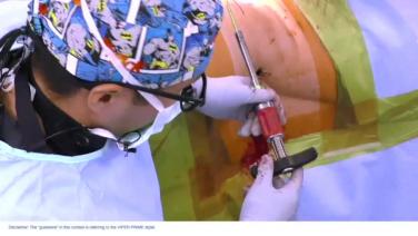 Anterior to Psoas (ATP): Single Position Percutaneous Screw Placement with Chi Lim, MD