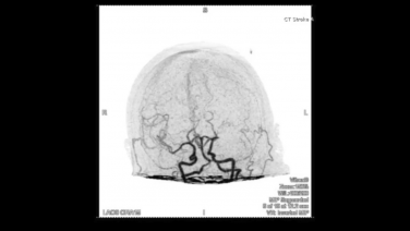 An image from the "Use of the EMBOTRAP® Device in Conjunction with Solumbra Technique for Left M1 Occlusion with Adnan Siddiqui, MD" video on the JnJInstitute.com website.