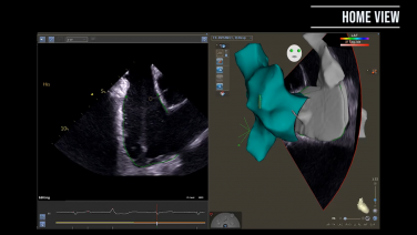 An image from the "Obtaining ICE Views to Visualize Ventricular Anatomy with Joshua Silverstein, MD" video on the JnJInstitute.com website.