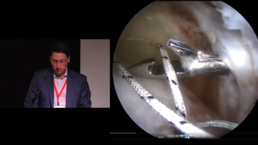 image of "Superior Capsular Reconstruction Key Surgical Steps with Paul Favorito, MD" video on jnjinstitute.com