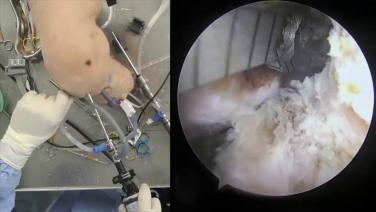 An image from the "ACL Reconstruction - Tunnel Drilling Utilizing the TWISTR™ Retrograde Reamer & Cruciate+ Instruments with Amir Moinfar, MD" video on the JnJInstitute.com website.