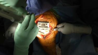An image from the "Total Knee Arthroplasty with ATTUNE® Knee System: Femoral Prep" video on the JnJInstitute.com website.