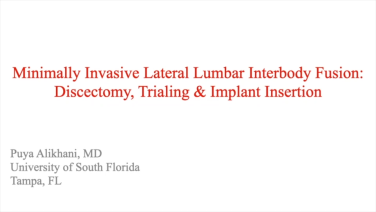 An image from the "Direct Lateral Approach: Discectomy, Implant Trialing, & Implant Placement -with Puya Alikhani, MD" video on the JnJInstitute.com website.