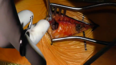 An image from the "Direct Lateral Approach: The Approach with Puya Alikhani, MD" video on the JnJInstitute.com website.