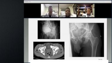 An image from the "The Utility of Continuous Compression Implants for Trauma Application: Posterior Column Fractures Case Presentation with Brian Cross, DO; Paul Gladden, MD; Patrick Wiater, MD" video on the JnJInstitute.com website.