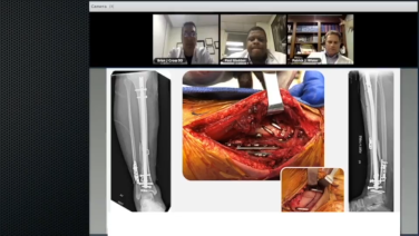 An image from the "The Utility of Continuous Compression Implants for Trauma Applications: Lower Extremity Fractures Case Presentation with Brian Cross, DO; Paul Gladden, MD; Patrick Wiater, MD" video on the JnJInstitute.com website.