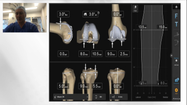 An image from the "Patient Specific Alignment: Tibia First Navigated Balance TKA Approach ArthroTopic" video on the JnJInstitute.com website.