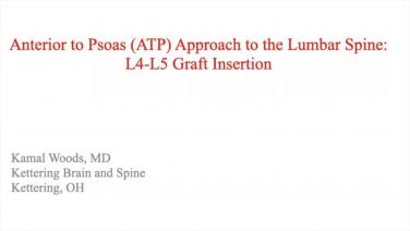 Anterior to Psoas (ATP) Approach to the Lumbar Spine: L4-L5 Graft Insertion