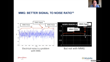 An image from the "Understanding Nerve Status: SENTIO™ MMG for use in Decompressions with Stephen Bartol, MD" video on the JnJInstitute.com website.