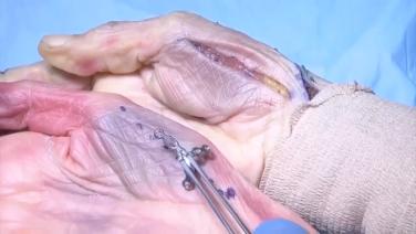 An image from the "VA Locking Hand System with Thomas Fischer, MD" video on the JnJInstitute.com website.