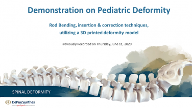 An image from the "Demonstration on Pediatric Deformity: Rod Bending, Insertion, & Corrective Techniques with Suken Shah, MD" video on the JnJInstitute.com website.