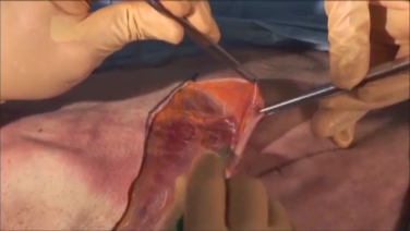 An image from the "Posterolateral Thoracotomy Approach to Rib Fractures with Steve Madey, MD & Bill Long, MD" video on the JnJInstitute.com website.