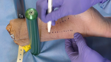 An image from the "Posterior Ankle Fracture Fixation Surgical Technique: Making the Incision with Megan Paulus, MD" video on the JnJInstitute.com website.