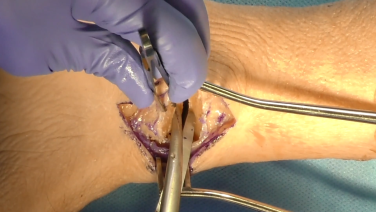 An image from the "Medial Malleolus Fracture Reduction Technique: Landmarks with Megan Paulus, MD" video on the JnJInstitute.com website.
