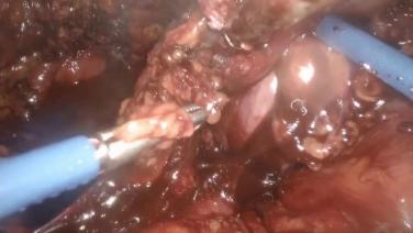 An Image from "Resection of a Persistent Marginal Ulcer and Creation of a New Gastrojejunostomy"