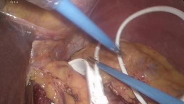 An Image from "Adjustable Band for a Failed RNY Gastric Bypass"