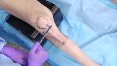 An image from the "RFN-Advanced Retrograde Femoral Nailing System (RFNA): Opening the Distal Femur with Matthew Graves, MD" video on the JnJInstitute.com website.