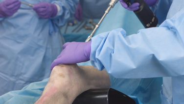 An image from the "TFN-ADVANCED Tibial Nailing System: Suprapatellar Approach: Opening the Tibia with Matthew Graves, MD" video on the JnJInstitute.com website.