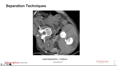 An image from the "Microwave Ablation of Liver and Kidney with Khashayar Farsad, MD" video on JnJInstitute.com