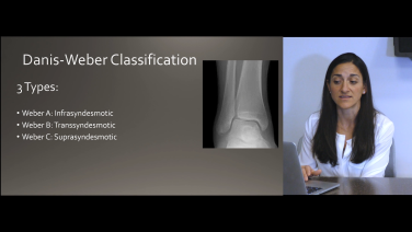 Am image from the "Ankle Fracture Classifications & Approaches: Dani-Weber Classification with Megan Paulus, MD" video on the JnJInstiotute.com website.