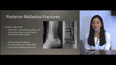 An image from the "Ankle Fracture Classification and Approaches: Posterior Malleolus Fractures & Syndesmotic Instability with Megan Paulus, MD" video on the JnJInstitute.com website.