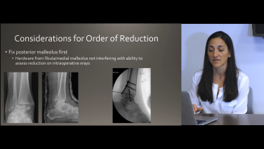 Am image from the "Ankle Fractures Classifications: Order of Reduction with Megan Paulus, MD" video on the JnJInstitute.com website.