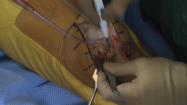 An image from the "ATTUNE® Knee System Surgical Insights: Exposure with Douglas Dennis, MD & Robert Gorab, MD" video on the JnJInstitute.com website.