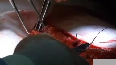 An image from the "XCM Biologic Tissue Matrix Component Separation Technique" video on the JnJInstitute.com website.