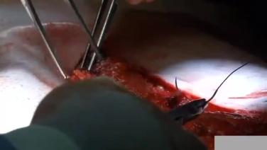 An image from the "XCM Biologic Tissue Matrix Component Separation Technique" video on the JnJInstitute.com website.