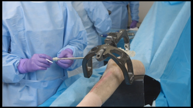 An image from the "TFN-ADVANCED Tibial Nailing System: Dynamic Compression with Matthew Graves, MD" video on the JnJInstitute.com website.