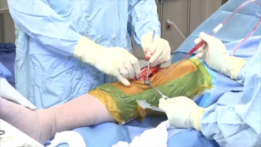 An image from the "ATTUNE® Rotating Platform: Measured Resection with Peter James, MD & Robert Gorab, MD" video on the JnJInstitute.com website.