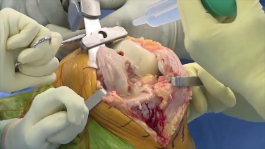 An image from the "ATTUNE® Knee System Surgical Insights - Bone Resection with David Fisher, MD, Peter James, MD & Robert Gorab, MD" video on the JnJInstitute.com website.