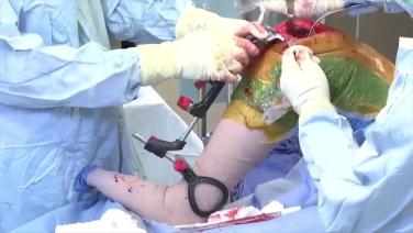 An image from the "ATTUNE® Rotating Platform: Bone Resection with Peter James, MD & Robert Gorab, MD" video on the JnJInstitute.com website.