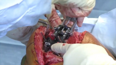 An image from the "Femoral Measured Resection with Peter James, MD & Robert Gorab, MD" video on the JnJInstitute.com website.