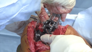 An image from the "Femoral Measured Resection with Peter James, MD & Robert Gorab, MD" video on the JnJInstitute.com website.