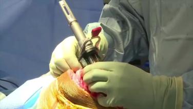 image of "ATTUNE® RP: Femoral Balance Rotation with Peter James, MD & Robert Gorab, MD" on jnjinstitute.com