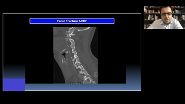Anterior Cervical Approach Case Presentation with Eiman Shafa, MD thumbnail