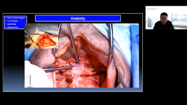 Occipitocervical Surgical Technique Case Study with R. Todd Allen, MD, PhD thumbnail