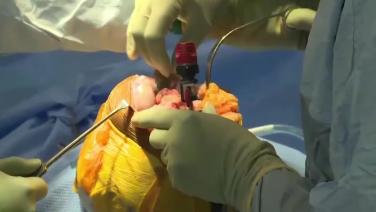 An image from the "ATTUNE® Roatating Platform: Tibia Resection with Peter James, MD" video on the JnJInstitute.com website.