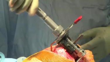 An image from the "ATTUNE® RP: Extension & Flexion Gap Sizing with Peter James, MD" video on the JnJInstitute.com website.