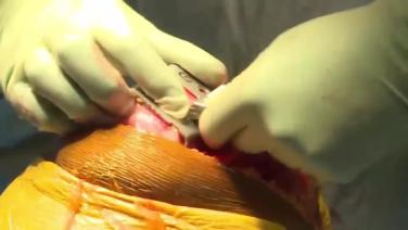 image of "ATTUNE RP: Making the Femoral Cuts with Peter James, MD" video on jnjinstitute.com
