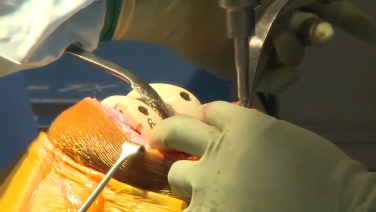 An image from the "ATTUNE® Rotating Platform: Insert the Tibial Trialing Plate with Peter James, MD" video on the JnJInstitute.com website.