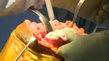 An image from the "ATTUNE® Rotating Platform: Cementing the Implants with Peter James, MD" video on the JnJInstitute.com website.
