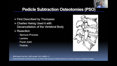 An image from the "Osteotomies: Pedicle Subtraction with Stuart Hershman, MD" video on the JnJInstitute.com website.