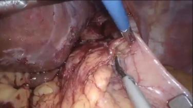 An Image from "Laparoscopic Sleeve Gastrectomy with preserving Nissen Fundoplication"